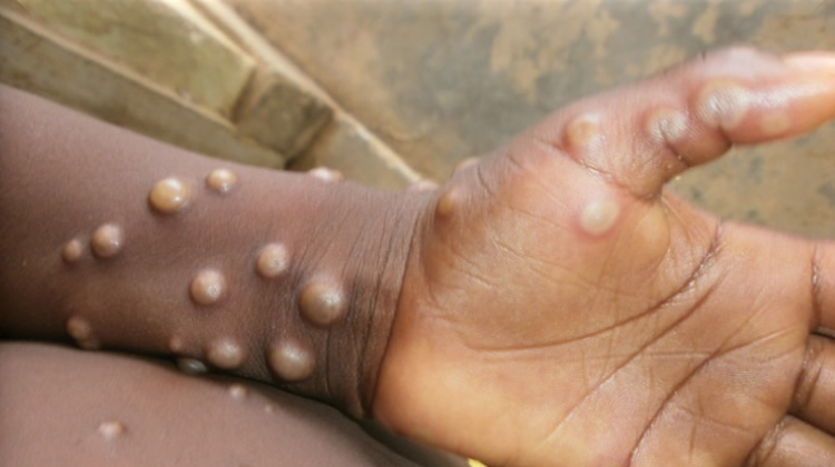 Key facts about&nbsp;Monkeypox